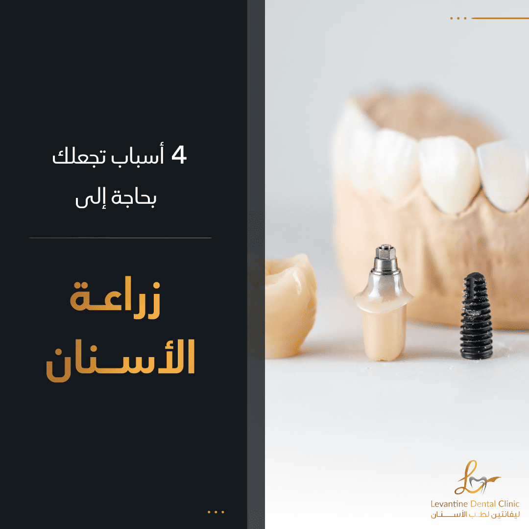 4 أسباب تجعلك بحاجة لزراعة الأسنان