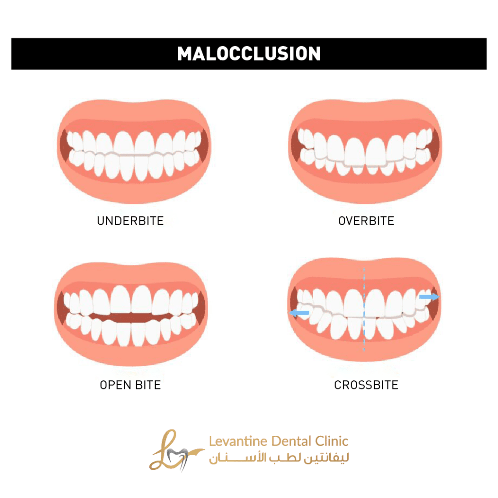 how braces can address jaw alignment issues like overbites, underbites, and crossbites. Get expert insights on benefits, types, and treatment options.