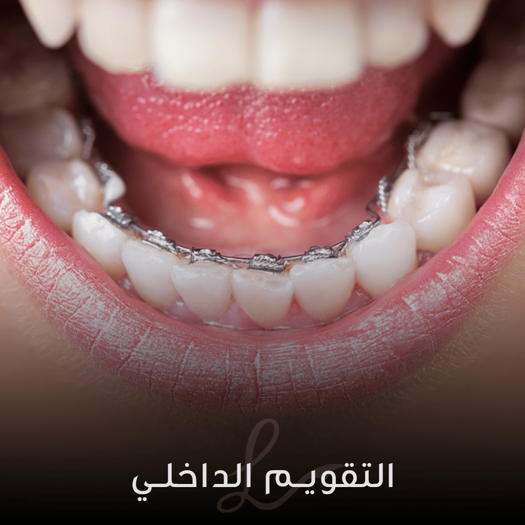 LINGUAL BRACES The Different Types of Orthodontic BRACES: Which Type is Right for You?