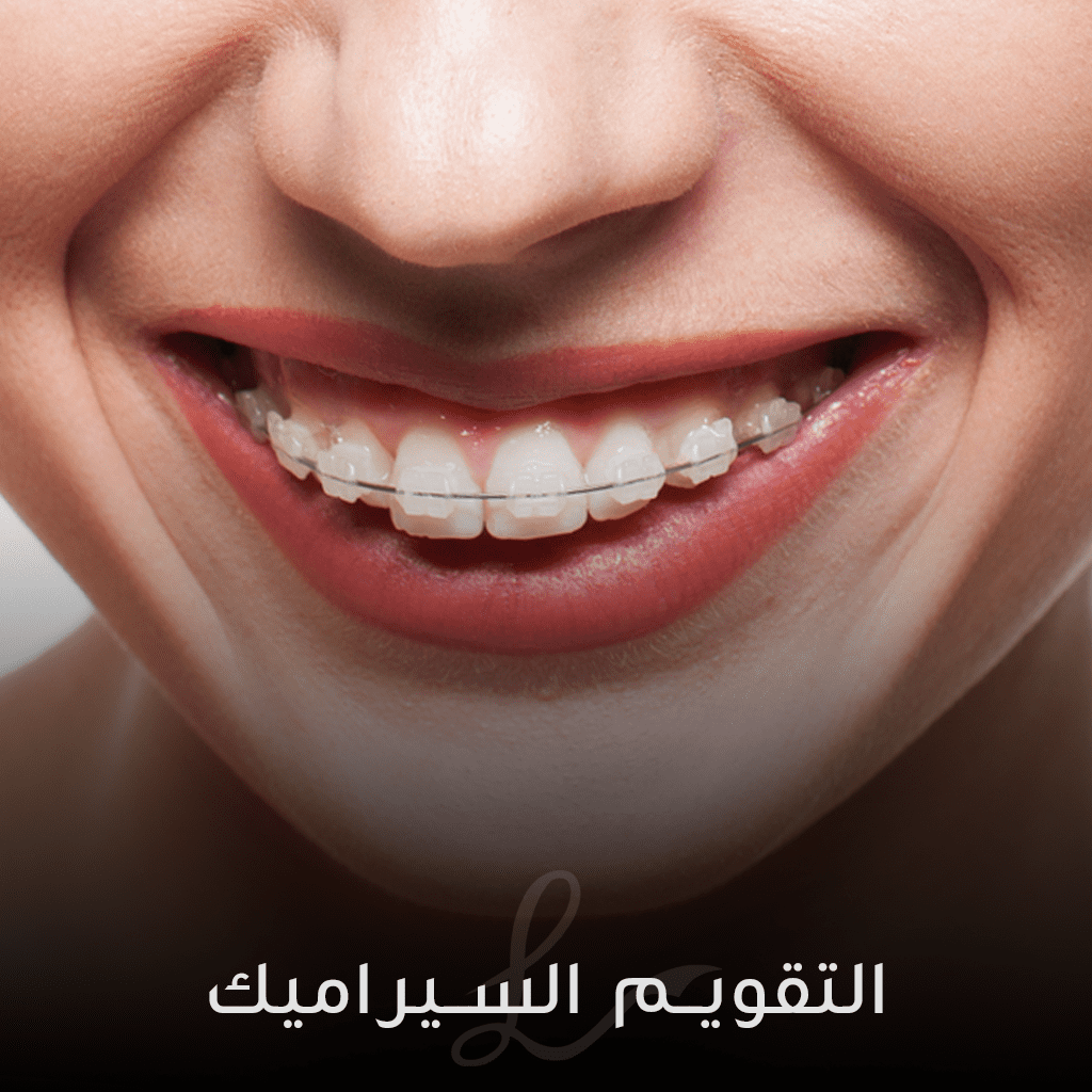 CERAMIC BRACES The Different Types of Orthodontic BRACES: Which Type is Right for You?