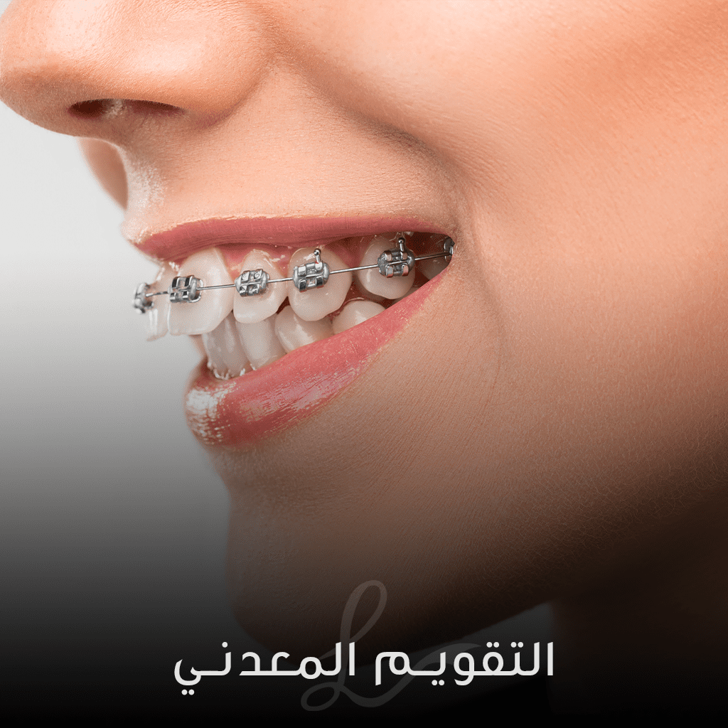 metallic Braces The Different Types of Orthodontic BRACES: Which Type is Right for You?