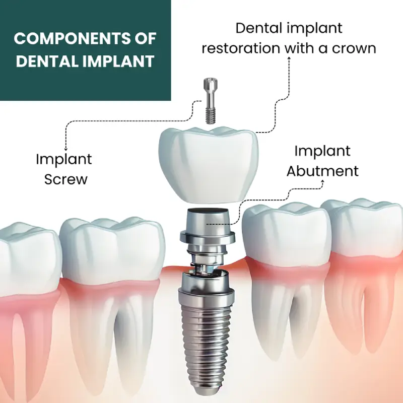 image 58 dental Implant