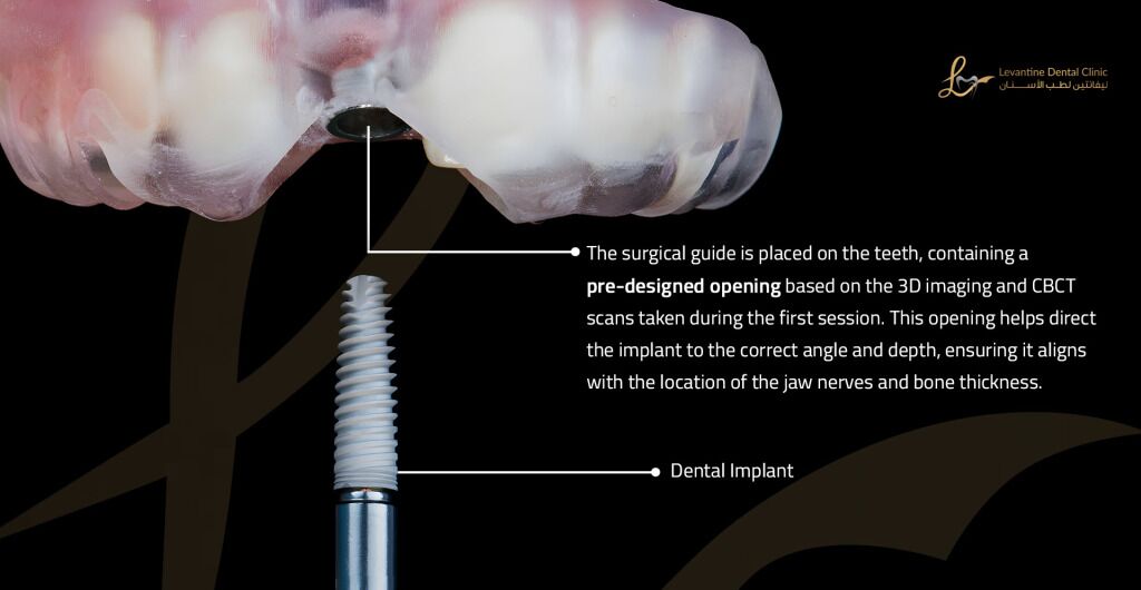Painless Dental Implants in Minutes! Using Surgical Guide Technology (No Scalpel or Stitches) 1 surgical guide Painless Dental Implants in Minutes! Using Surgical Guide Technology (No Scalpel or Stitches)